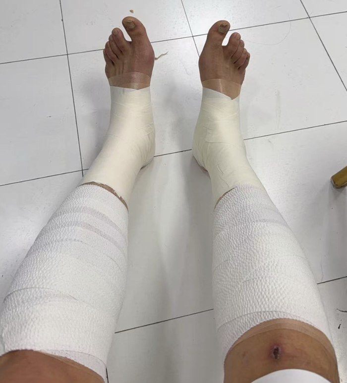 澳客体育-胜山西谁注意翟晓川赛后伤势？双腿拉伤绑满绷带，看着都残忍！|北京|篮板|比赛|王治郅|复出_新浪体育_新浪新闻